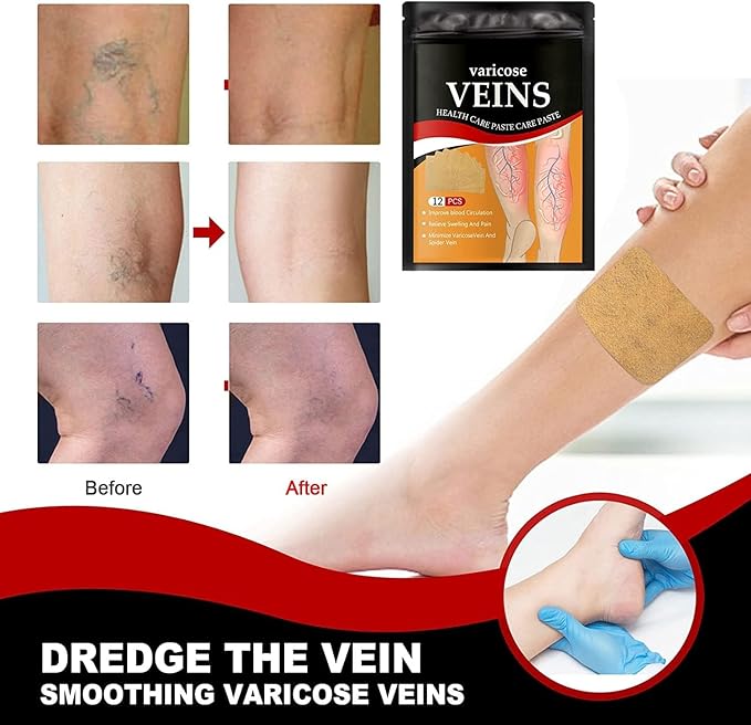 VEINEASE™ Spider & Varicose Vein Patches | 12 Patches | natural Herbal Therapy for Swelling, Fatigue & Vein Health